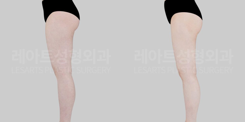 하체비만 지방흡입 전후 사진 - 레아트 성형외과 서용승 원장