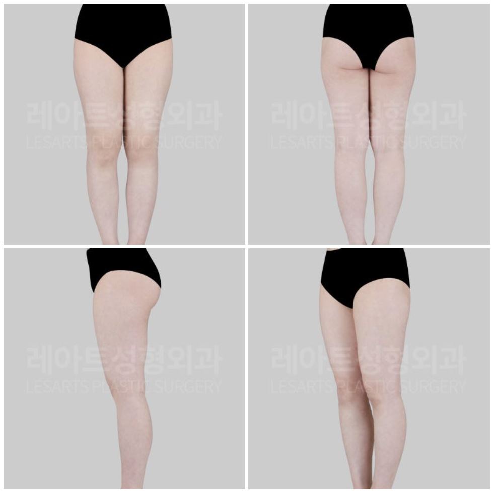 허벅지 지방흡입 수술 전 체형진단