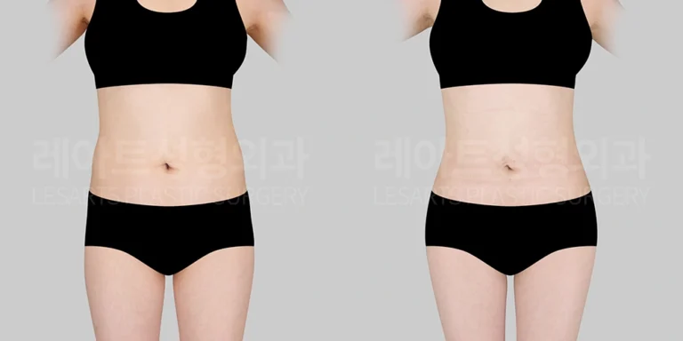 복부 지방흡입 + 골반지방이식 전후 변화 - 레아트 성형외과