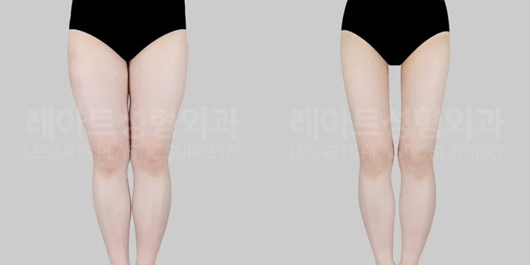 허벅지 지방흡입 전후 비교 1년 - 레아트 성형외과