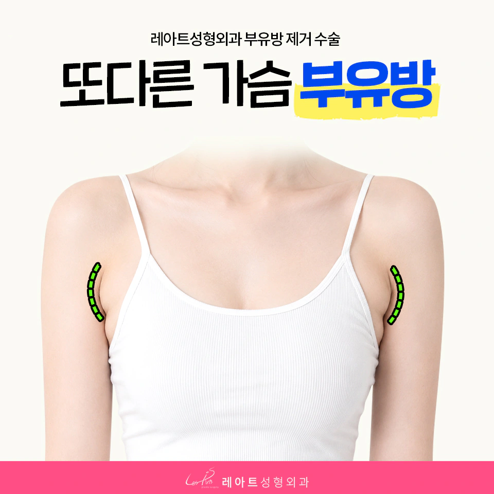 부유방 제거 수술 - 레아트 성형외과 문지훈 원장