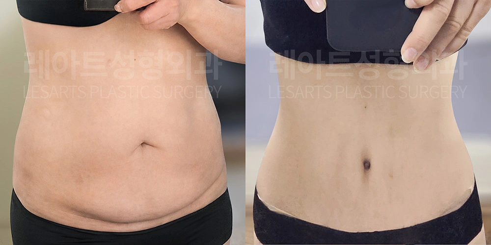 50대 북부거상 수술 3개월 후기 - 레아트 성형외과