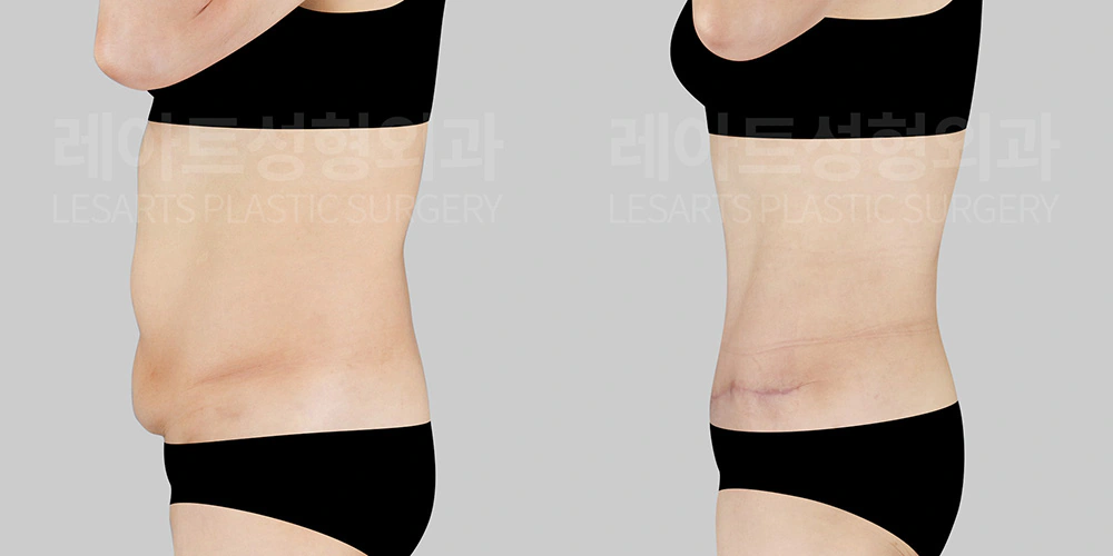 50대 아랫배 처짐, 복부거상수술 - 레아트 성형외과