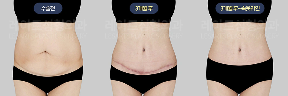 50대 후반 복부거상 수술 3개월차 회복상태 - 레아트 성형외과