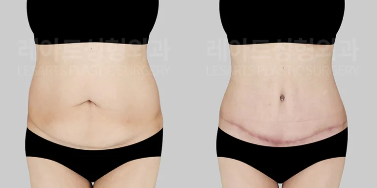 50대 후반 복부거상 수술 후기 - 레아트 성형외과