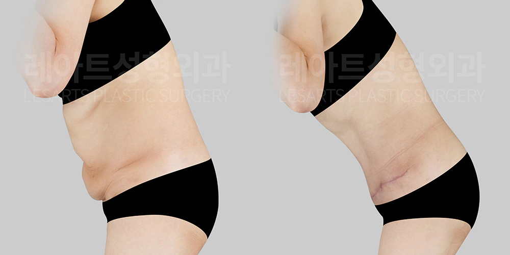 복부거상 수술 전후 비교 - 레아트 이국한 원장
