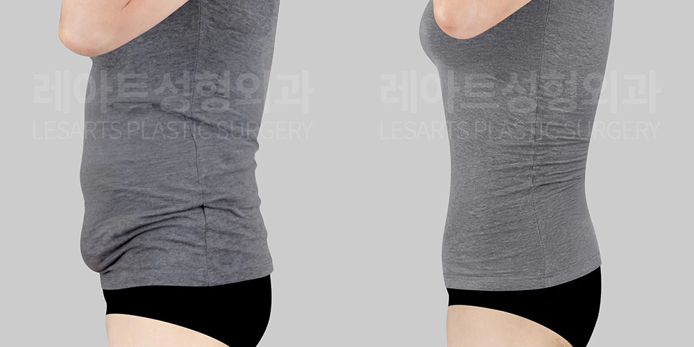 복부거상, 지방흡입 수술 전후 티셔츠 핏
