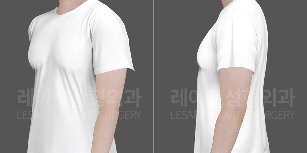 여유증 수술 전 얇은 반팔 티셔츠 핏