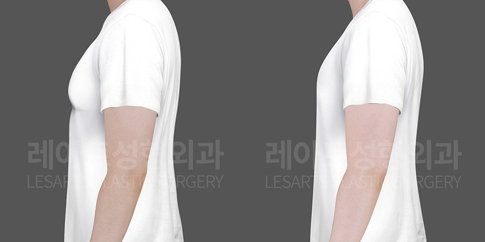 여유증 수술 7개월 경과 - 레아트 성형외과