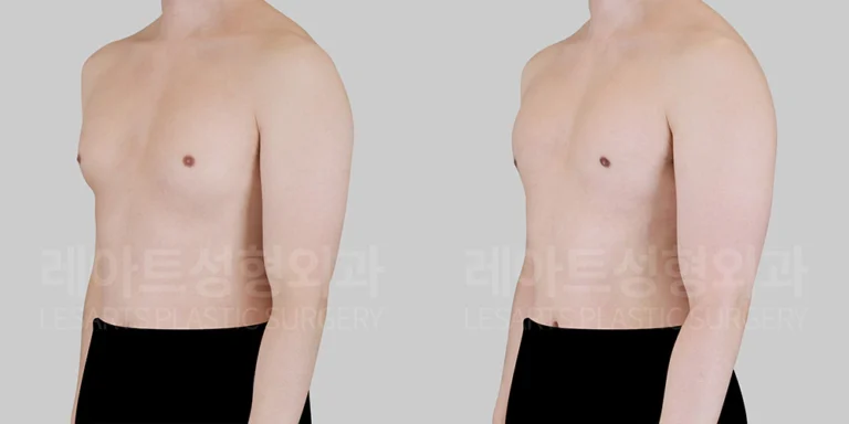 여유증 수술 반년 후 회복상태 - 레아트 성형외과