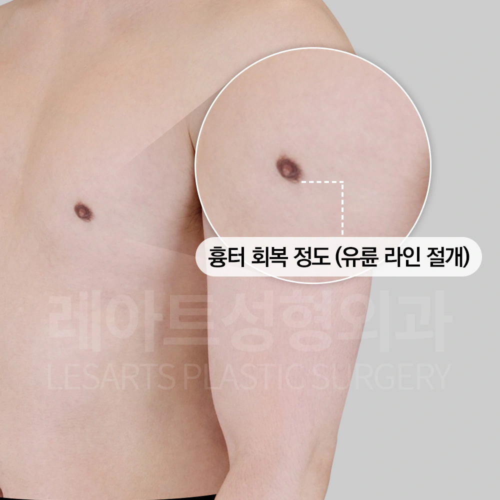 여유증 수술 반년 후 흉터 상태
