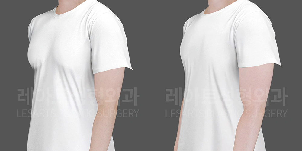 여유증 수술 전후 티셔츠 핏 비교