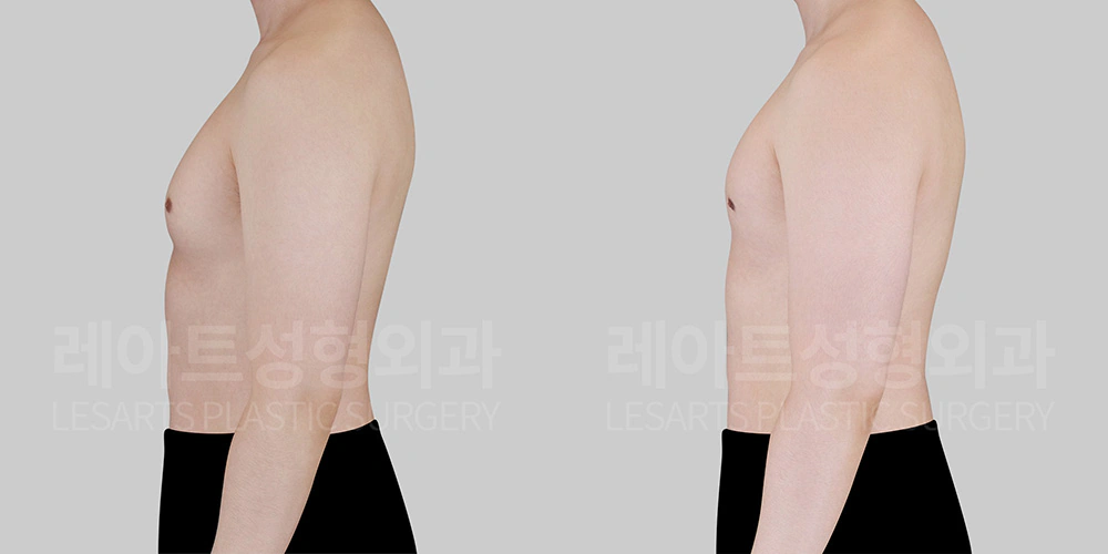 여유증 수술 후 가슴 돌출도 변화
