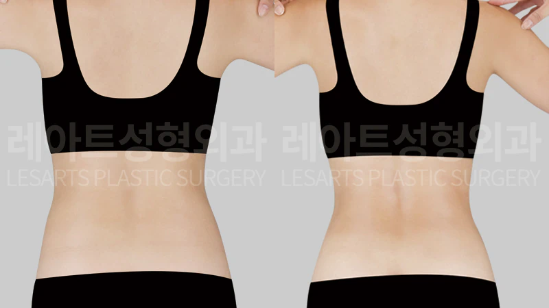 [복부지방흡입 1개월 반 후 뒤에서 본 옆구리와 허리라인 변화]