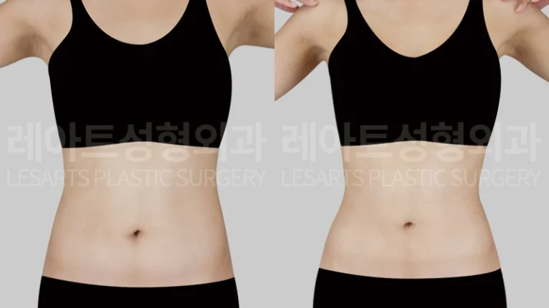 복부지방흡입 | 다이어트로 안 빠지는 옆구리살, 1개월 반 후 허리라인 변화