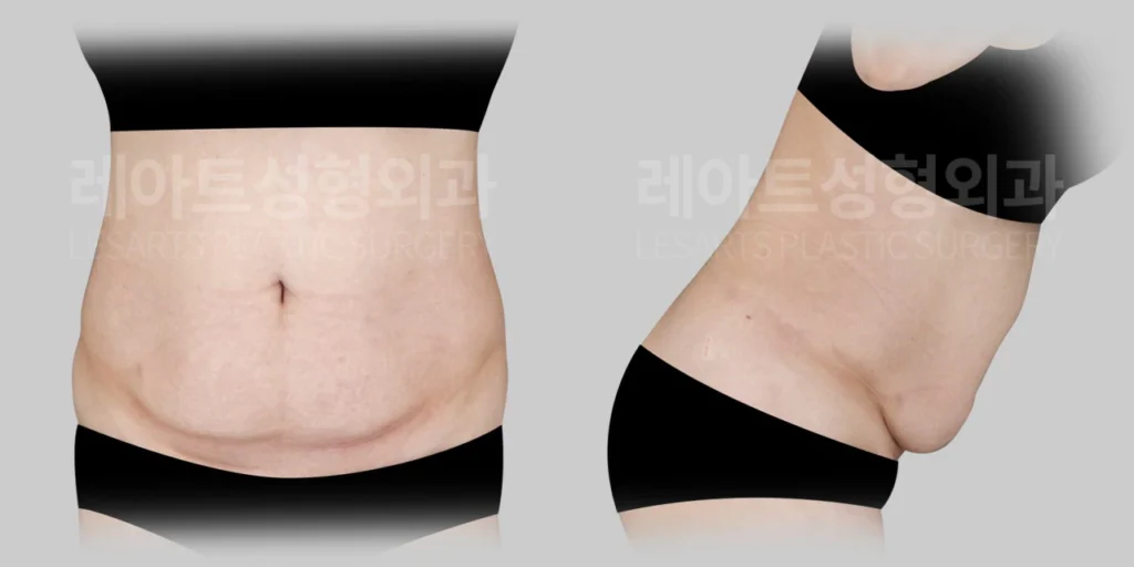 [배꼽 아래 피부 처짐과 아랫배 접힘이 나타난 수술 전 상태]