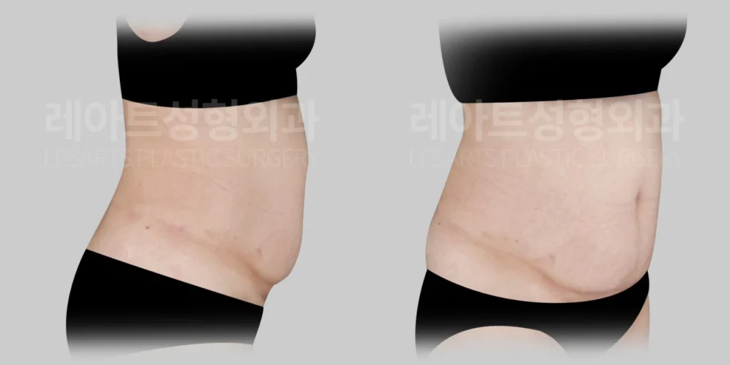 [배꼽 플로팅 S타입 미니복부거상 수술 계획]