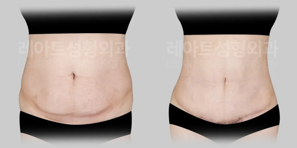 [복부거상수술 7개월 후, 하복부 피부 처짐과 허리라인 변화]