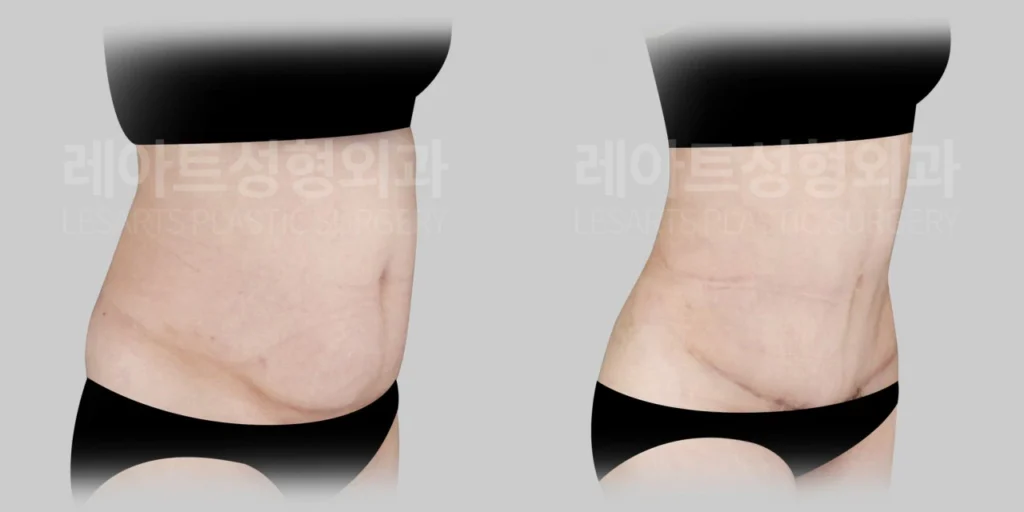 [복부거상수술 7개월 후, 하복부 돌출과 피부 처짐 변화]