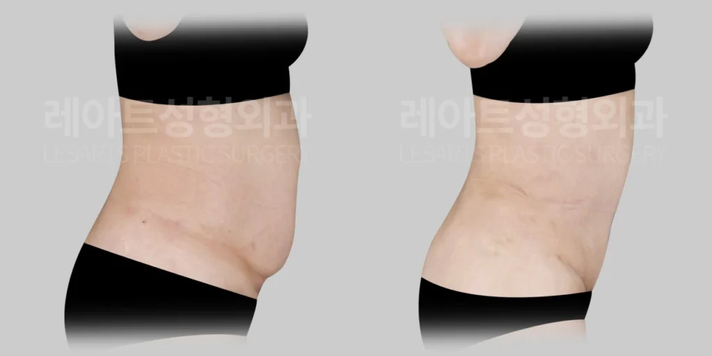 [복부거상수술 7개월 후, 옆모습에서 확인한 아랫배 돌출 변화]