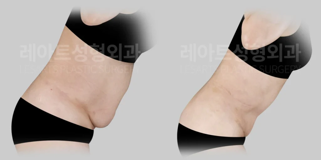 [복부거상수술 7개월 후, 허리를 숙였을 때 확인한 하복부 피부 접힘 변화]