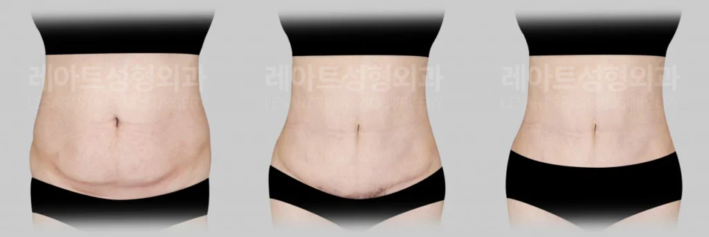 [복부거상수술 7개월 후, 팬티라인 안쪽 절개선과 흉터 회복 상태]