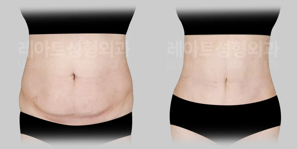 미니복부거상 | 절개가 길어질 수 있을까? 배꼽 플로팅 7개월 변화