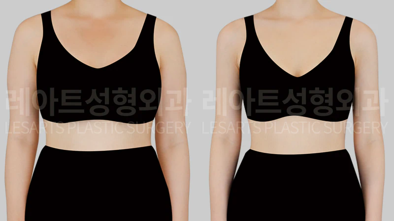 팔 지방흡입 수술 전후 8개월, 정면에서 본 일자팔 변화