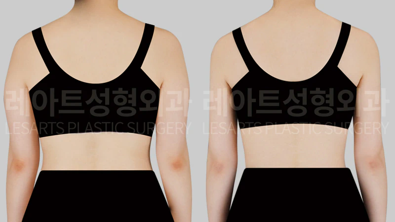 팔지방흡입 수술 전후 8개월, 뒷면에서 본 뒷볼록 라인 변화