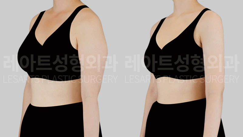 팔지방흡입 수술 전후 8개월, 반측면에서 본 팔 바깥쪽 라인 변화