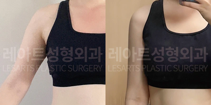 팔지방흡입 수술 전 및 3개월 차 셀카 비교