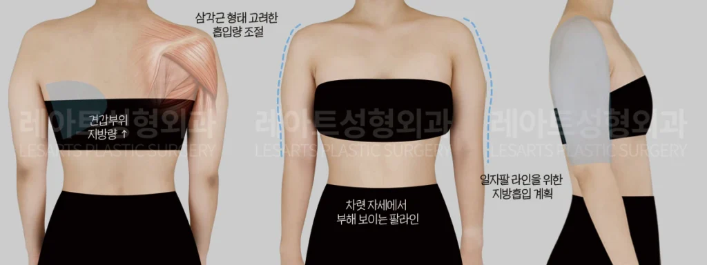 [팔지방흡입 수술 전, 차렷 자세에서 부해 보였던 상체라인 분석]
