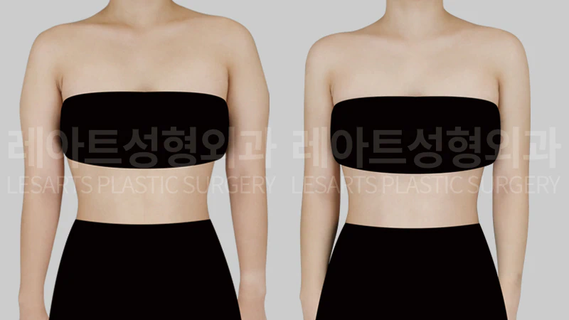 [팔지방흡입 수술 전후 5개월, 정면에서 본 팔뚝 폭과 일자팔 라인 변화]