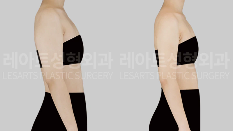 [팔지방흡입 수술 전후 5개월, 옆모습에서 본 팔의 앞뒤 폭과 뒷볼록 변화]