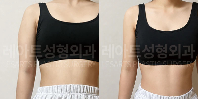 [팔지방흡입 수술 전과 2개월 후 셀카 비교]