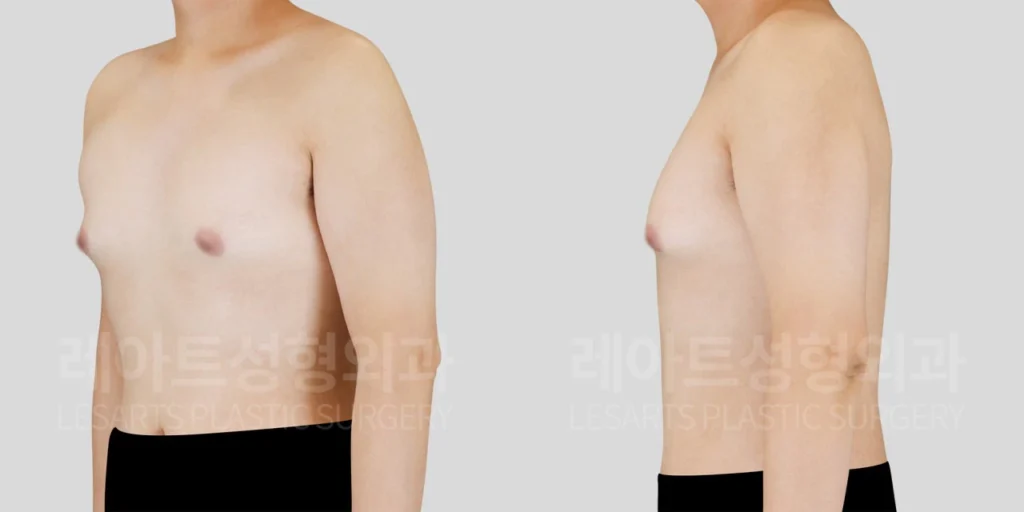 앞가슴 돌출과 양측 멍울, 가슴 두께가 확인된 수술 전 상태