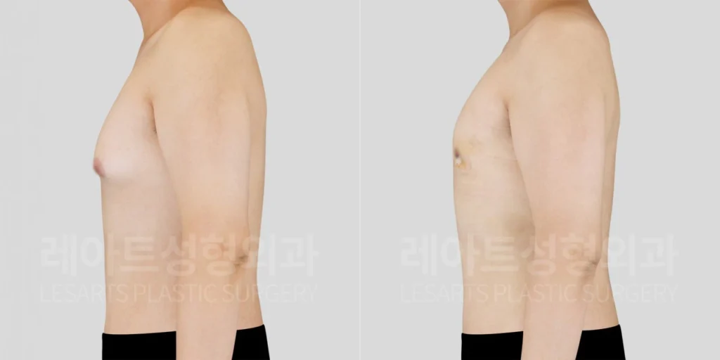남자여유증수술 2주후, 옆면에서 확인한 가슴 두꼐와 아래쪽 라인변화