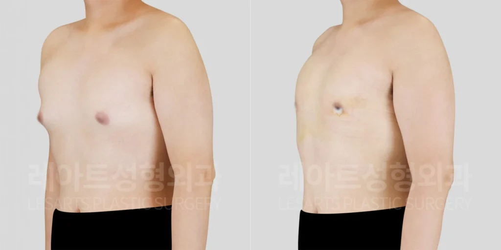 남자 여유증 수술 2주 후, 반측면에서 확인한 앞가슴 돌출 변화
