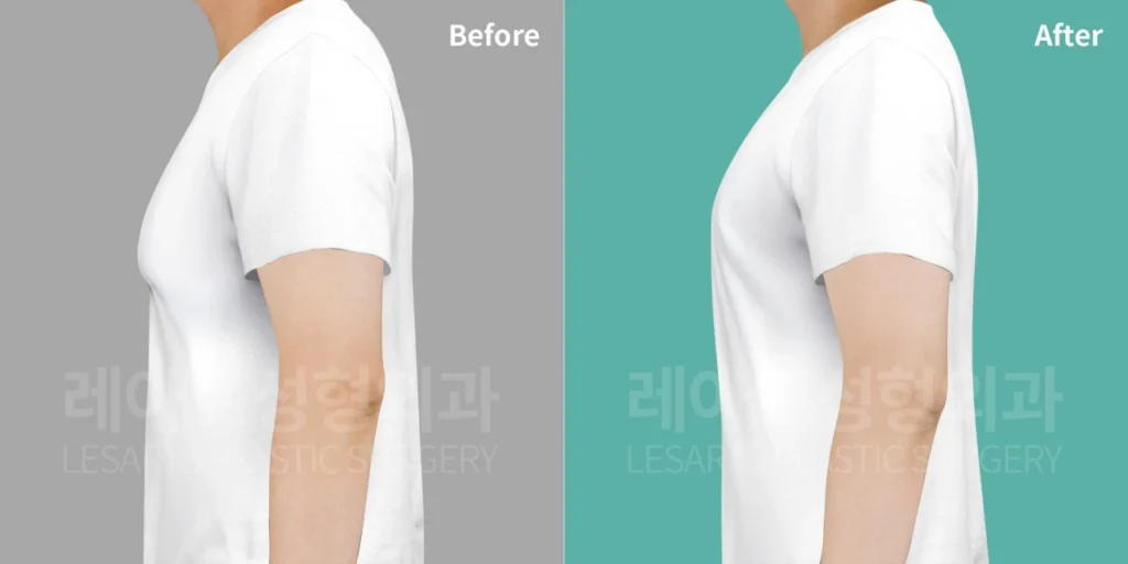 여유증 수술 2주후, 반팔 티셔츠입은 옆모습에서 확인한 앞가슴 돌출변화