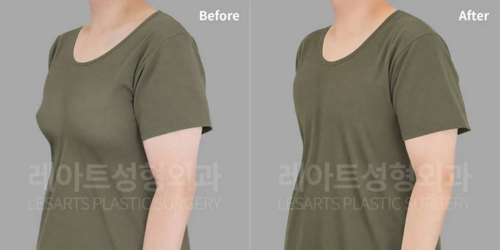 군인 여유증 수술 2주 후 티셔츠로 확인한 앞가슴 돌출 변화