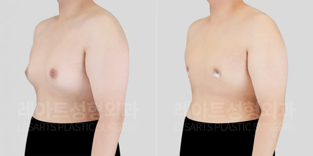 [남자 여유증수술 2주 후 반측면에서 확인한 앞가슴 돌출 변화]