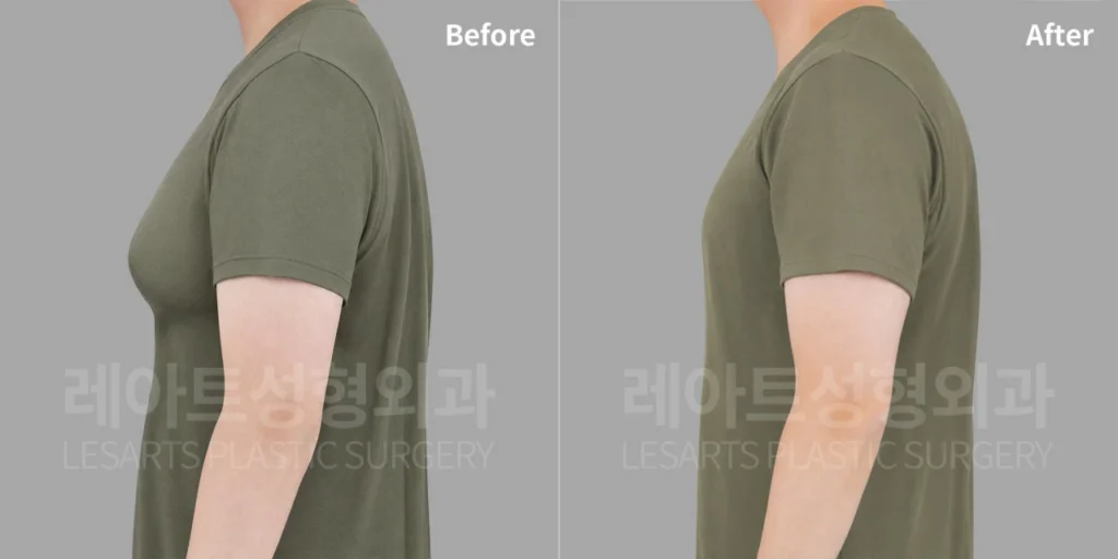 [군인 남자 여유증수술 2주 후 훈련복 티셔츠핏 변화]