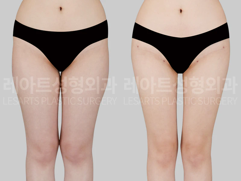 [허벅지지방흡입과 고관절지방이식 2개월 후, 골반과 허벅지라인 변화]