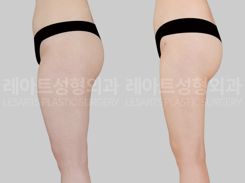 [허벅지지방흡입과 고관절지방이식 2개월 후, 옆모습으로 본 허벅지 두께와 골반라인 변화]