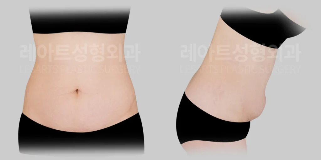 [하복부 처짐과 배꼽 아래 주름이 두드러졌던 수술 전 상태]
