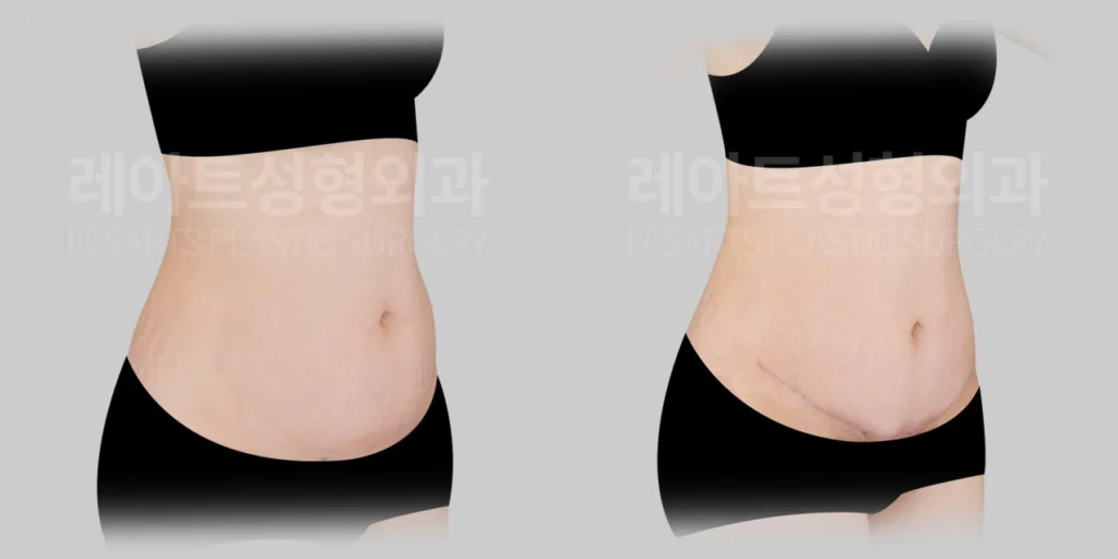 [미니복부거상수술 3개월 반 후, 반측면에서 본 복부 돌출 변화]