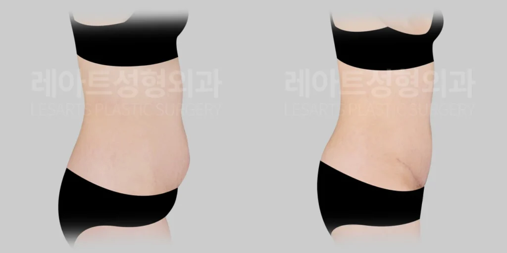 [미니복부거상수술 3개월 반 후, 옆모습에서 본 하복부 돌출 변화]