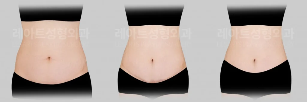 [미니복부거상수술 3개월 반 후, 팬티라인 안쪽에 자리 잡은 하복부 절개 흉터 변화]