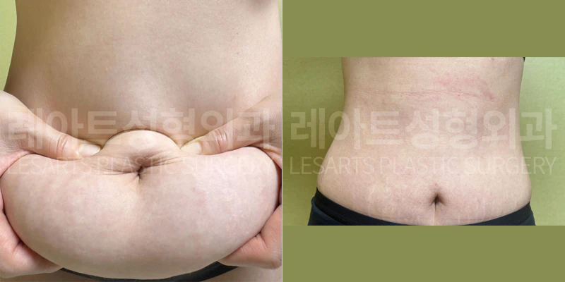 복부거상 수술전 / 한달 후 셀카 비교