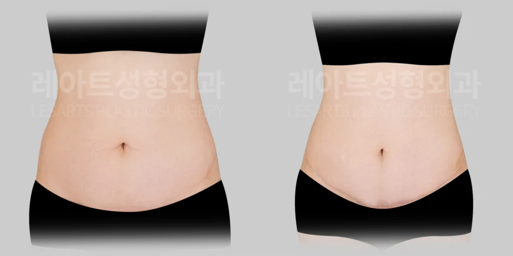[미니복부거상수술 3개월 반 후, 정면에서 본 하복부 피부 처짐 변화]